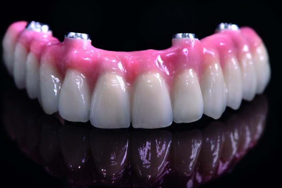 Prothèse plurale sur implants