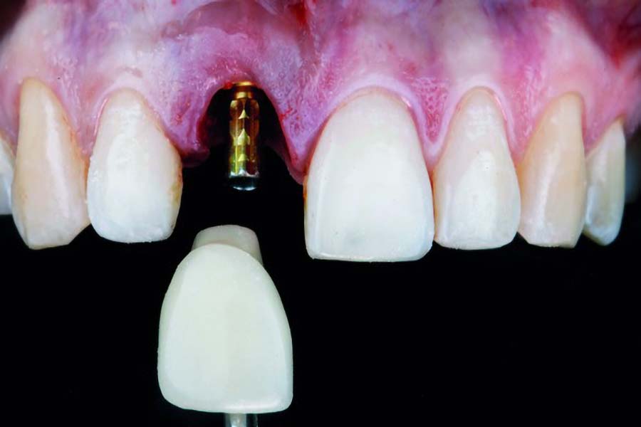 Prothèse scellée sur implant