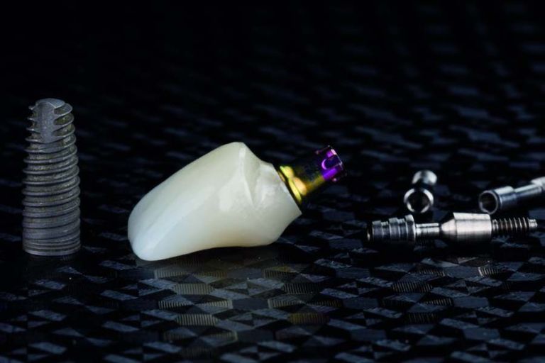 Prothèse transvissée sur implant